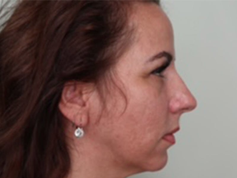 Filler Before & After Gallery - Patient 87642436 - Image 1
