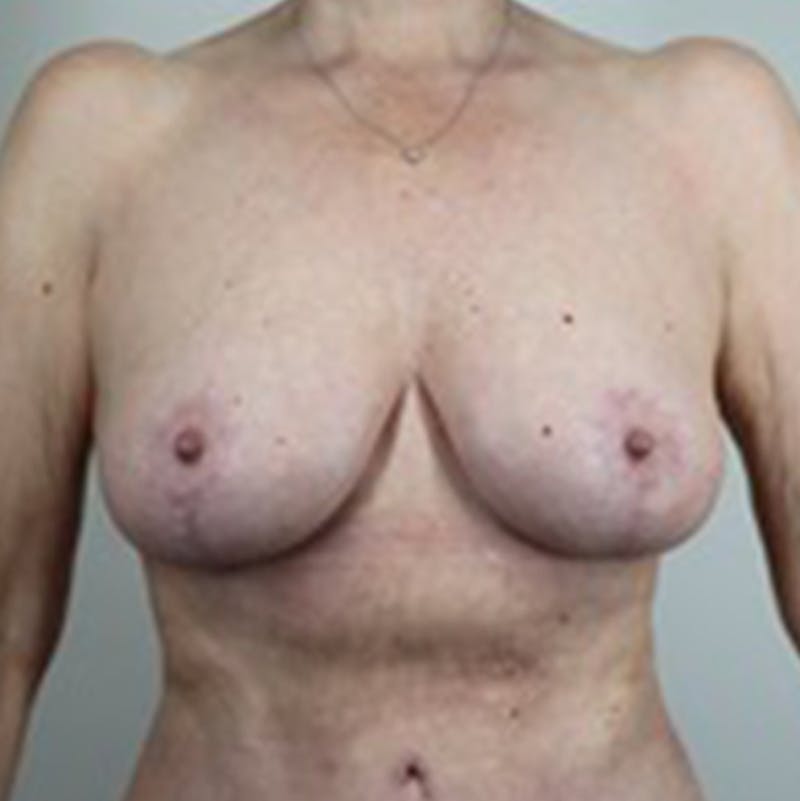 Breast Lift Before & After Gallery - Patient 87650439 - Image 2