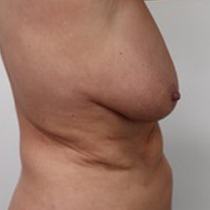 Breast Lift Before & After Gallery - Patient 87650439 - Image 3