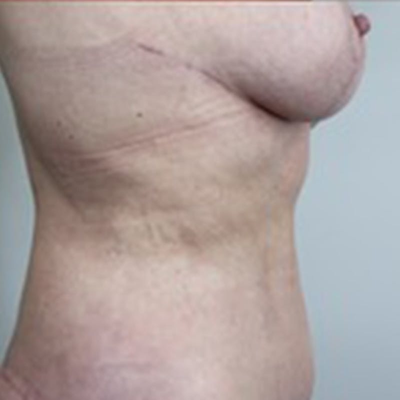 Breast Lift Before & After Gallery - Patient 87650439 - Image 4