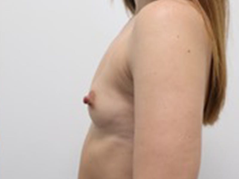 Breast Lift Before & After Gallery - Patient 87691621 - Image 5