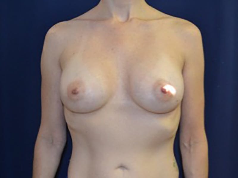 Breast Augmentation Before & After Gallery - Patient 87698068 - Image 6