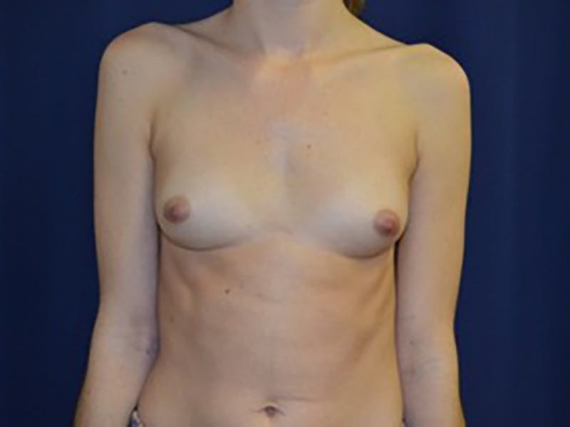 Breast Augmentation Before & After Gallery - Patient 87719588 - Image 1