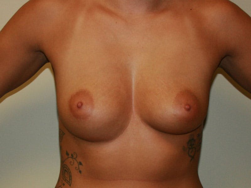 Breast Augmentation Before & After Gallery - Patient 87719589 - Image 1