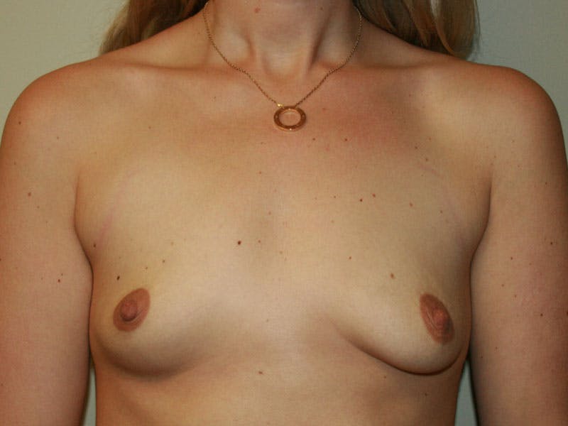 Breast Augmentation Before & After Gallery - Patient 87719590 - Image 1