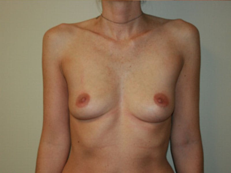 Breast Augmentation Before & After Gallery - Patient 87719603 - Image 1