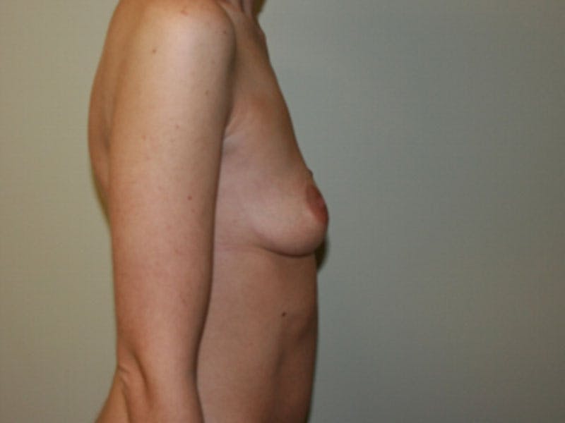 Breast Augmentation Before & After Gallery - Patient 87719603 - Image 3