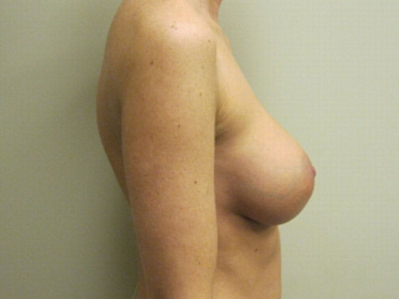 Breast Augmentation Before & After Gallery - Patient 87719603 - Image 4