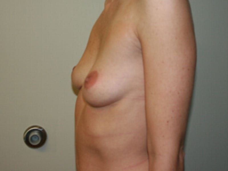 Breast Augmentation Before & After Gallery - Patient 87719603 - Image 5