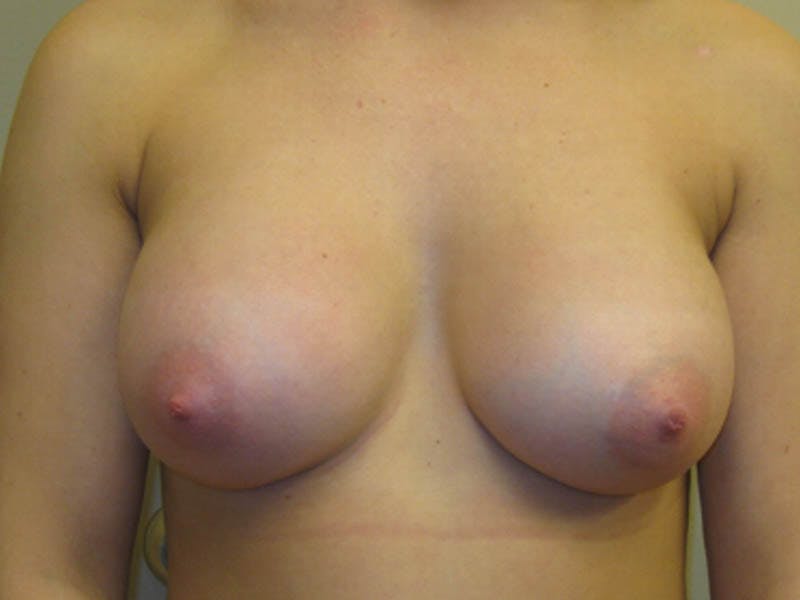 Breast Augmentation Before & After Gallery - Patient 87719604 - Image 4