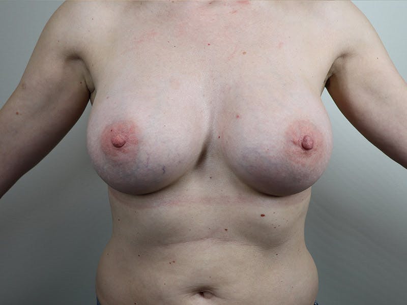Breast Augmentation Before & After Gallery - Patient 87719606 - Image 2