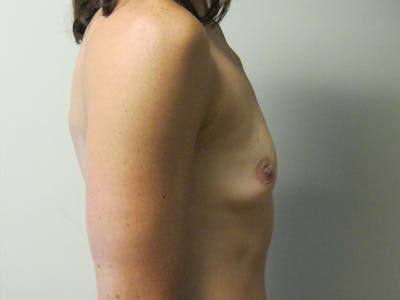 Breast Augmentation Before & After Gallery - Patient 87719607 - Image 1