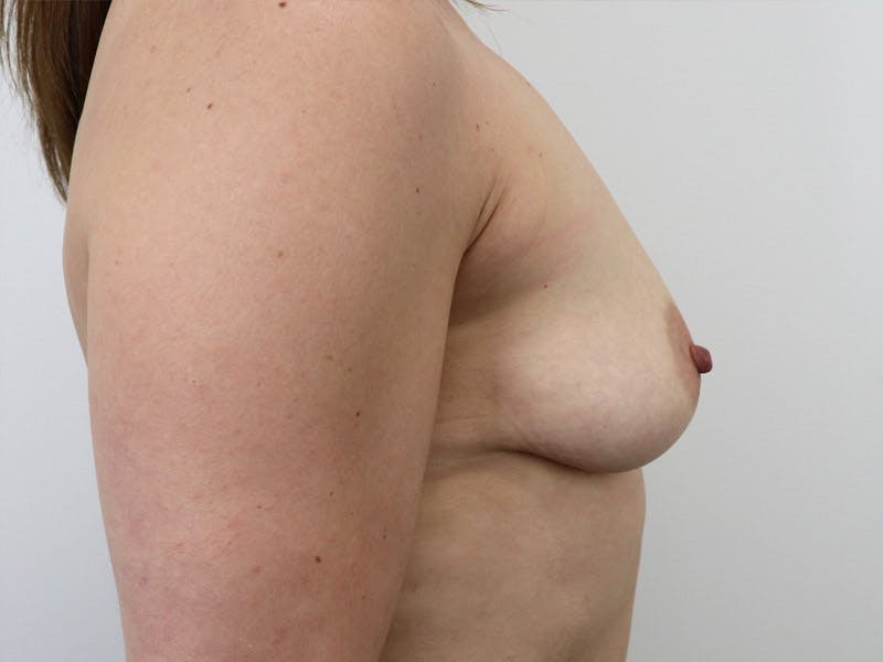 Breast Augmentation Before & After Gallery - Patient 87719619 - Image 5