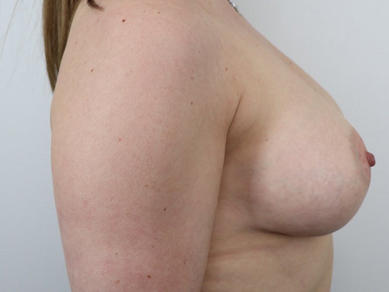 Breast Augmentation Before & After Gallery - Patient 87719619 - Image 6