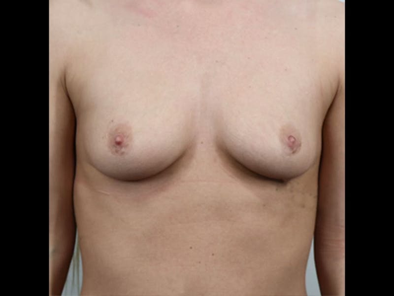 Breast Augmentation Before & After Gallery - Patient 87719635 - Image 1