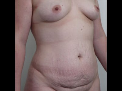 Breast Augmentation Before & After Gallery - Patient 87719636 - Image 1