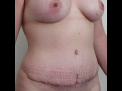 Breast Augmentation Before & After Gallery - Patient 87719636 - Image 2