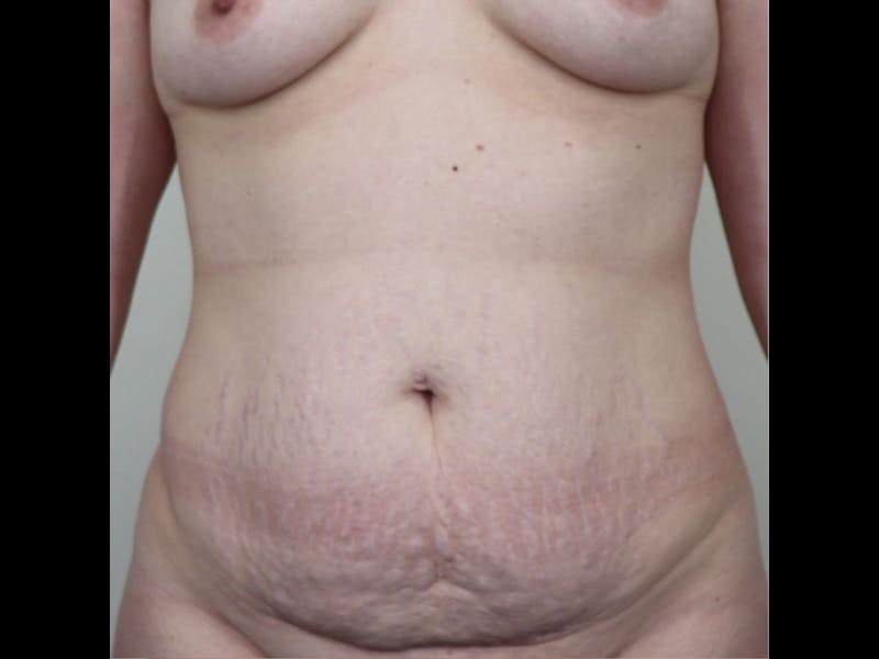 Breast Augmentation Before & After Gallery - Patient 87719636 - Image 3