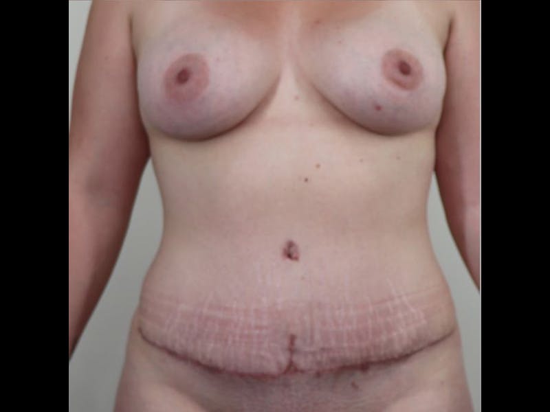 Breast Augmentation Before & After Gallery - Patient 87719636 - Image 4