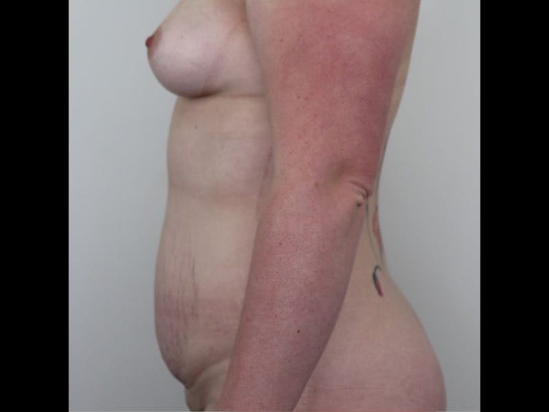 Breast Augmentation Before & After Gallery - Patient 87719636 - Image 5