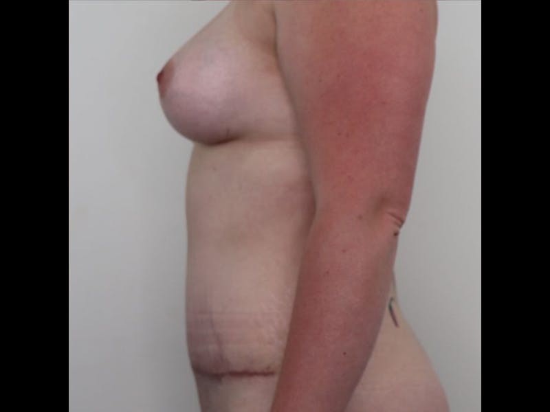 Breast Augmentation Before & After Gallery - Patient 87719636 - Image 6