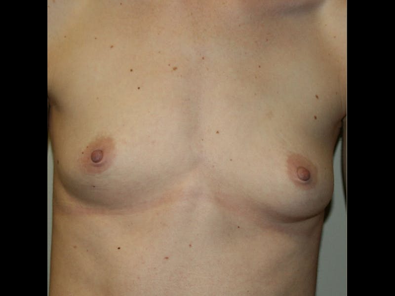 Breast Augmentation Before & After Gallery - Patient 87719637 - Image 3