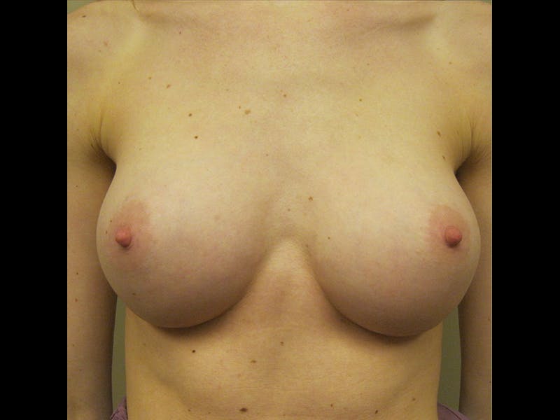Breast Augmentation Before & After Gallery - Patient 87719637 - Image 4