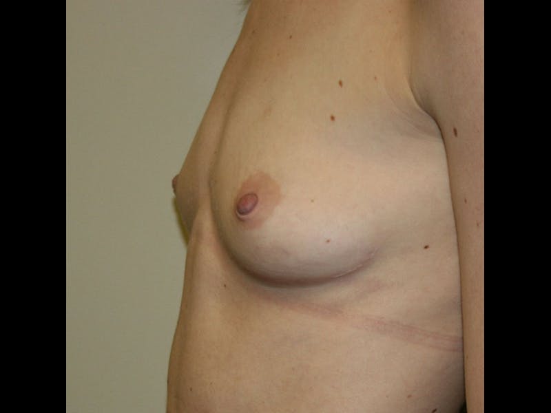 Breast Augmentation Before & After Gallery - Patient 87719637 - Image 5