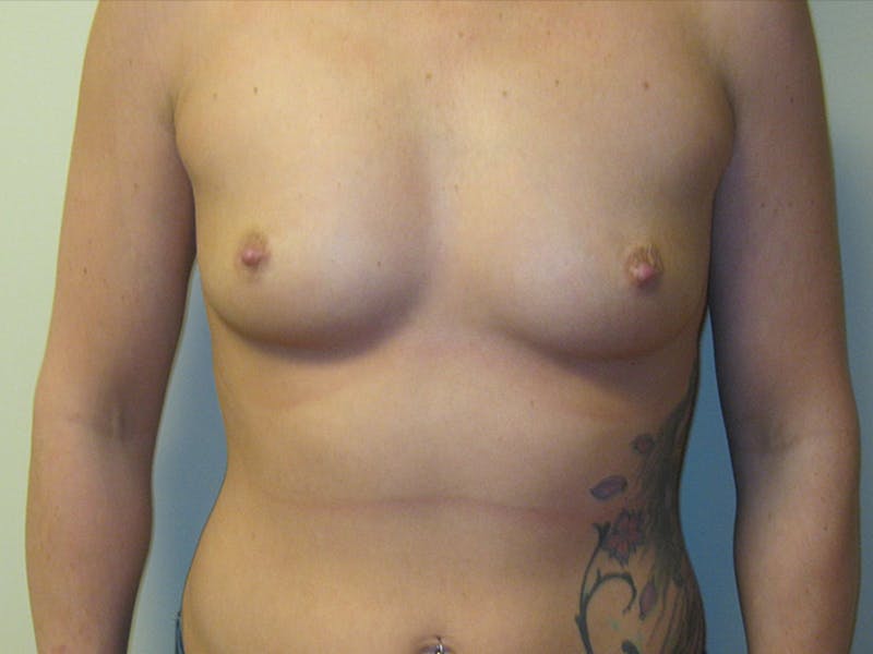 Breast Augmentation Before & After Gallery - Patient 87719638 - Image 1