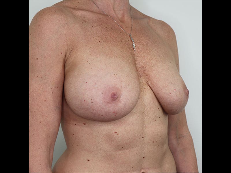 Breast Augmentation Before & After Gallery - Patient 87719639 - Image 1