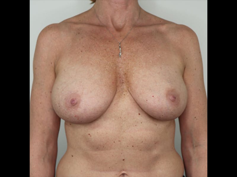 Breast Augmentation Before & After Gallery - Patient 87719639 - Image 3