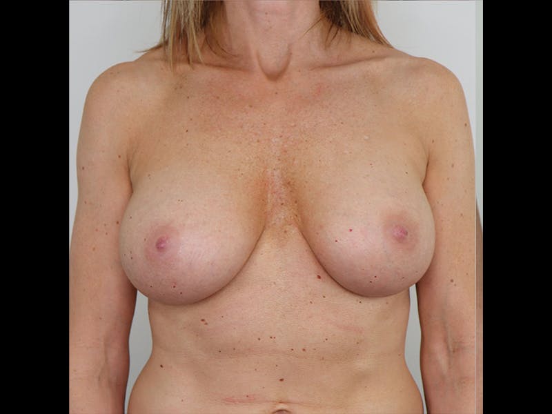 Breast Augmentation Before & After Gallery - Patient 87719639 - Image 4