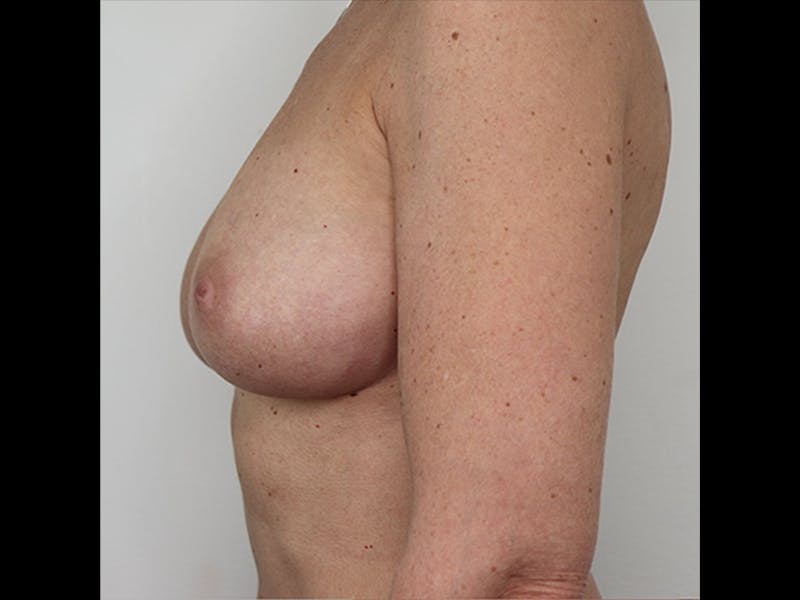 Breast Augmentation Before & After Gallery - Patient 87719639 - Image 5