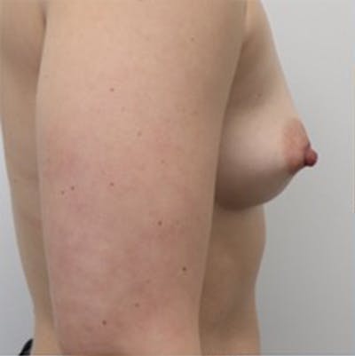 Breast Augmentation Before & After Gallery - Patient 87719675 - Image 1