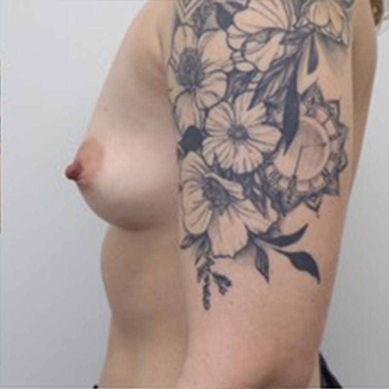 Breast Augmentation Before & After Gallery - Patient 87719675 - Image 5