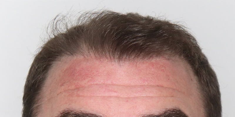 Neograft Before & After Gallery - Patient 106363135 - Image 2