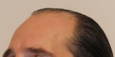 Neograft Before & After Gallery - Patient 106363134 - Image 1
