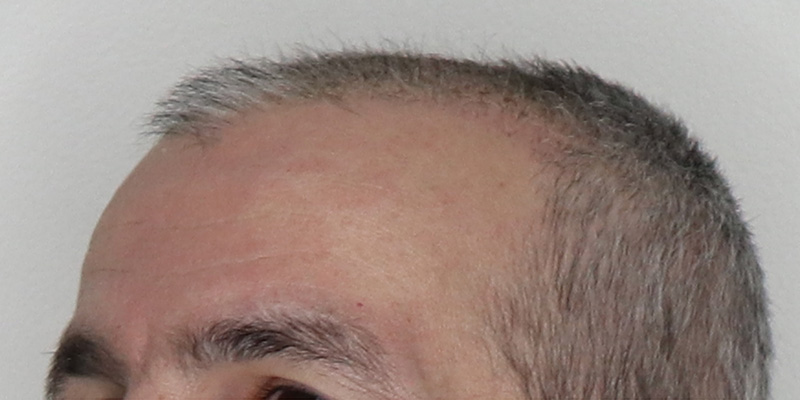 Top more than 151 hair transplant portland - camera.edu.vn