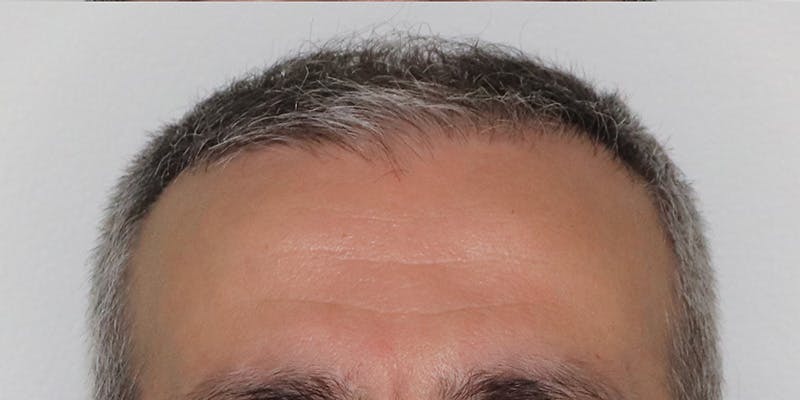 Neograft Before & After Gallery - Patient 106363133 - Image 6