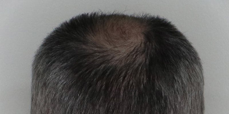 Neograft Before & After Gallery - Patient 106363133 - Image 7