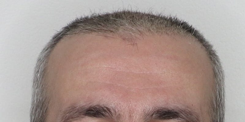 Neograft Before & After Gallery - Patient 106363133 - Image 5