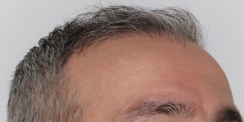 Neograft Before & After Gallery - Patient 106363133 - Image 4