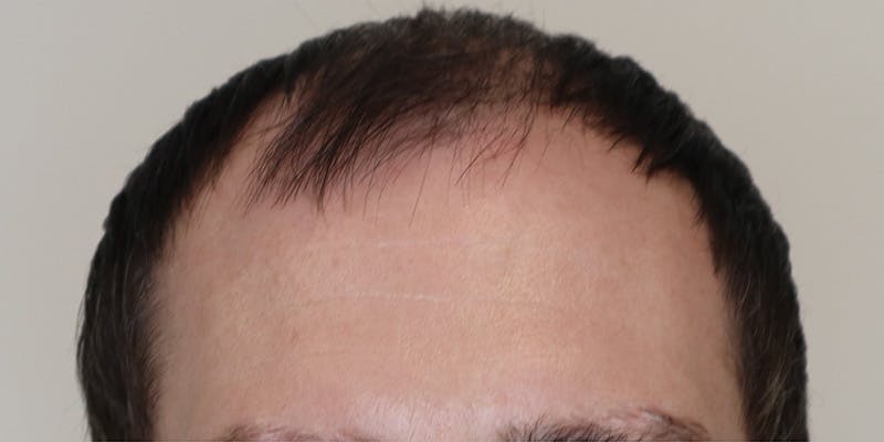 Neograft Before & After Gallery - Patient 106363132 - Image 1