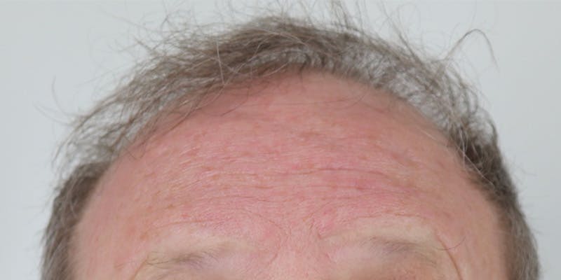 Neograft Before & After Gallery - Patient 106363131 - Image 1