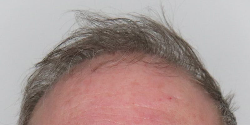 Neograft Before & After Gallery - Patient 106363131 - Image 2