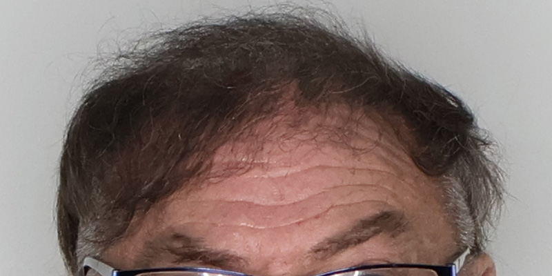 Aggregate 60+ hair transplant portland latest - in.eteachers