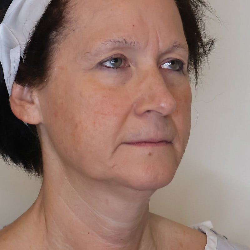 Necklift Before & After Gallery - Patient 429623 - Image 1