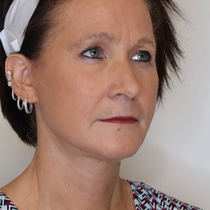 Facelift Before & After Gallery - Patient 232890 - Image 2