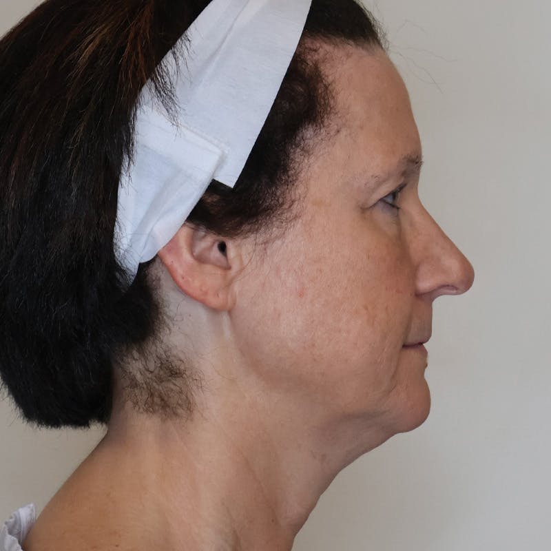 Necklift Before & After Gallery - Patient 429623 - Image 3