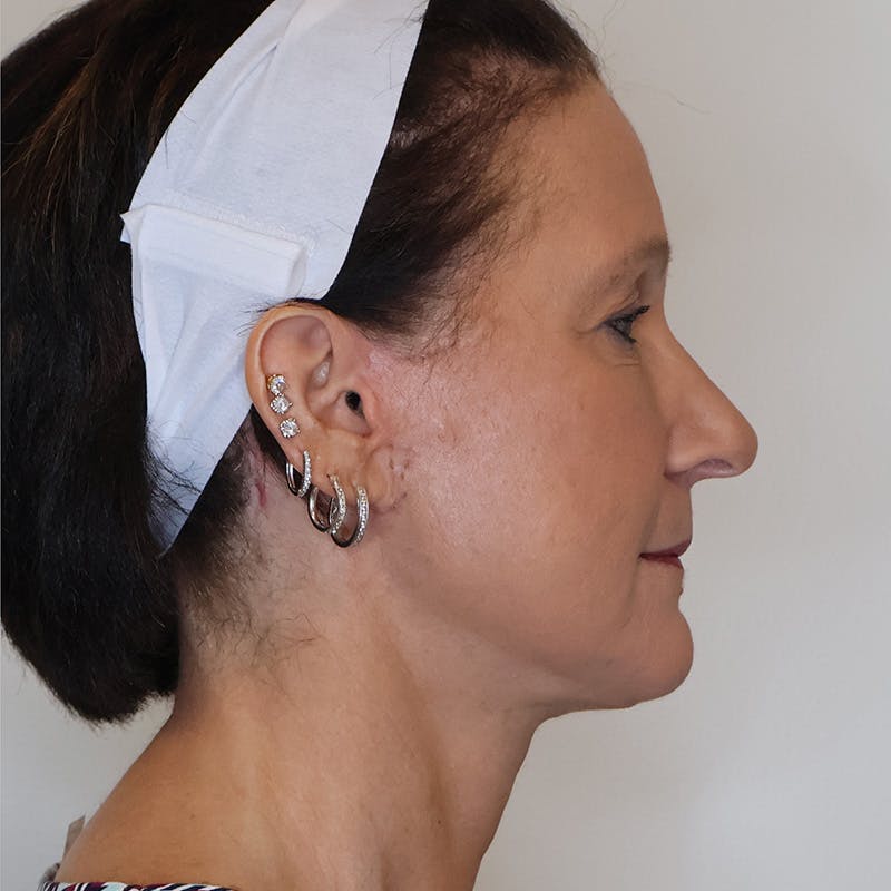 Necklift Before & After Gallery - Patient 429623 - Image 4